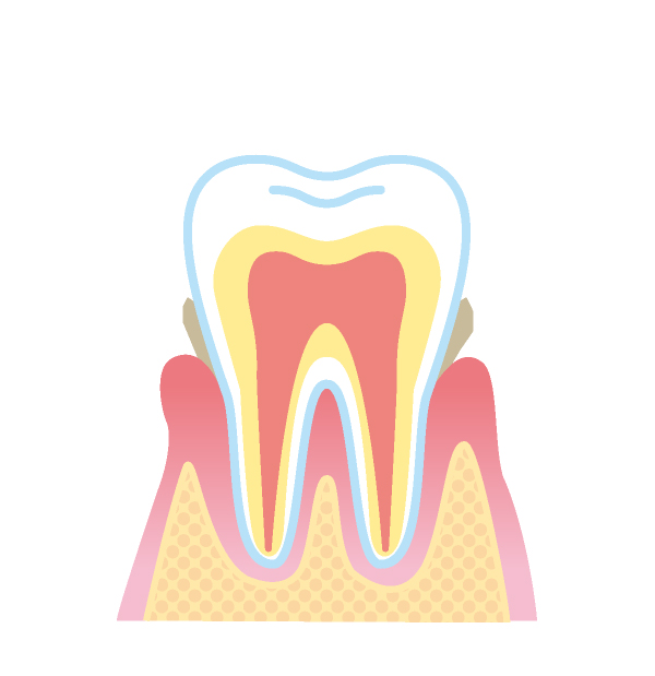 歯肉炎～軽度の歯周炎