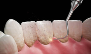 歯石除去