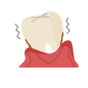 奥歯がぐらぐら